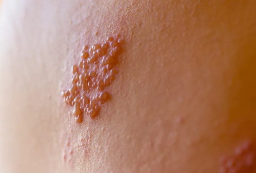 Inheriting the thousand-year-old scraping technique, shingles patients say goodbye to pain