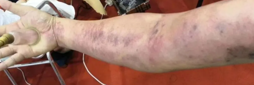 What exactly is scraping in traditional Chinese medicine? What is its principle?